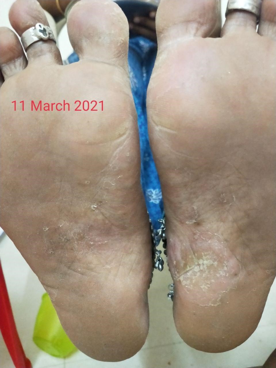 Psoriasis 3