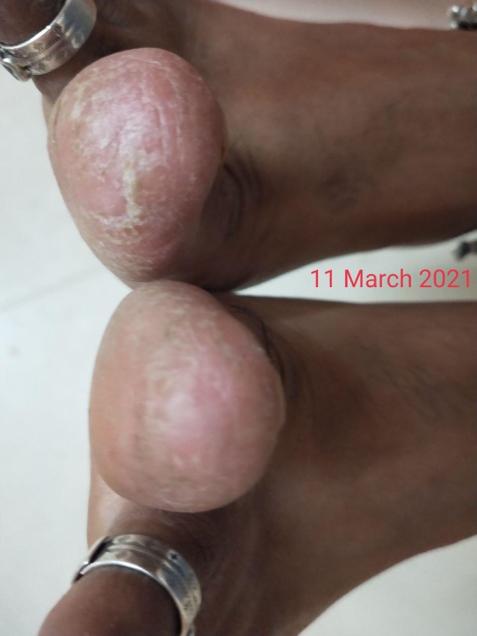 Psoriasis 4